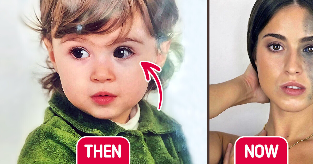 «At 8 Years Old I Could Not Leave House Without Makeup.» Model With Giant Birthmark Revealed a True Story of Self Love