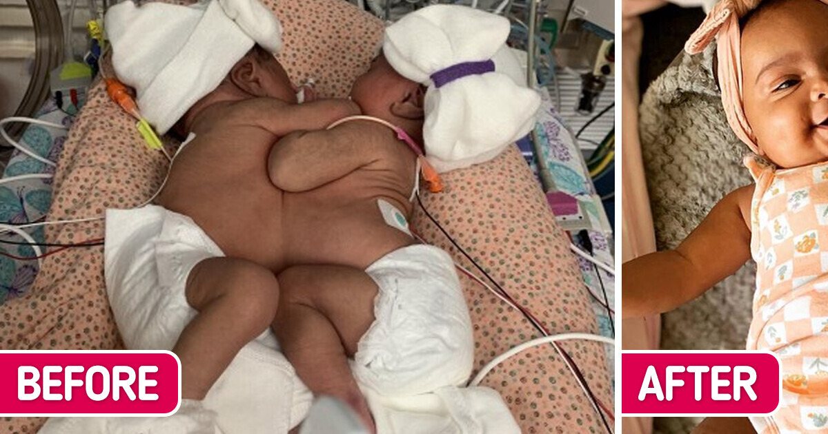 1-in-200,000: Conjoined Twins with a Shared Liver Successfully Separated After a Risky Surgery 1-in-200,000: Conjoined Twins with a Shared Liver Successfully Separated After a Risky Surgery