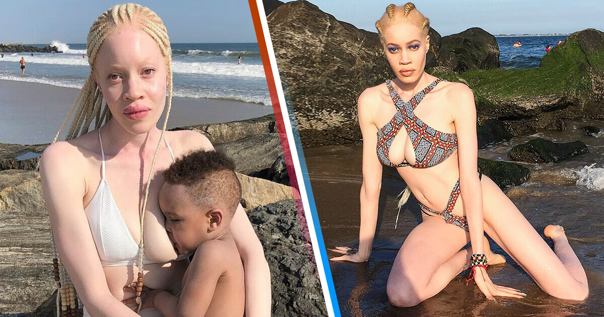 A Woman Faced Mockery and Skepticism Due to Her Albinism, But Now She Is Rocking the World’s Catwalks A Woman Faced Mockery and Skepticism Due to Her Albinism, But Now She Is Rocking the World’s Catwalks
