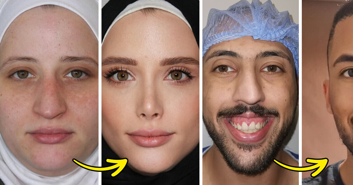People Can’t Believe These Plastic Surgery Transformations Using the Golden Ratio