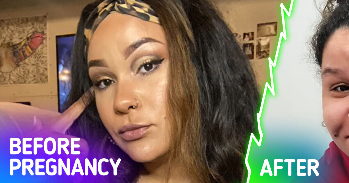 “It’s Like Two Different People”: A Young Woman Experiences Extreme “Pregnancy Nose”, Leaving Her Unrecognizable