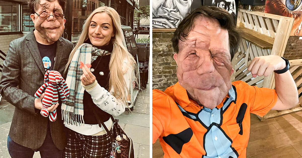 Awe Story of Adam Pearson, Who Chose Not to Suffer for Life from His Disorder, and Became a Role Model for Millions Awe Story of Adam Pearson, Who Chose Not to Suffer for Life from His Disorder, and Became a Role Model for Millions
