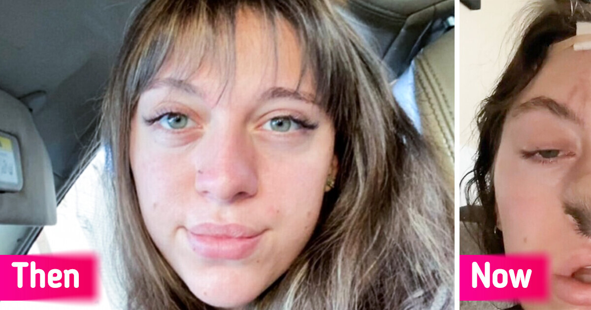 Young Woman Got Mauled by Dog, Now Adapting to a New Hairy Nose Young Woman Got Mauled by Dog, Now Adapting to a New Hairy Nose