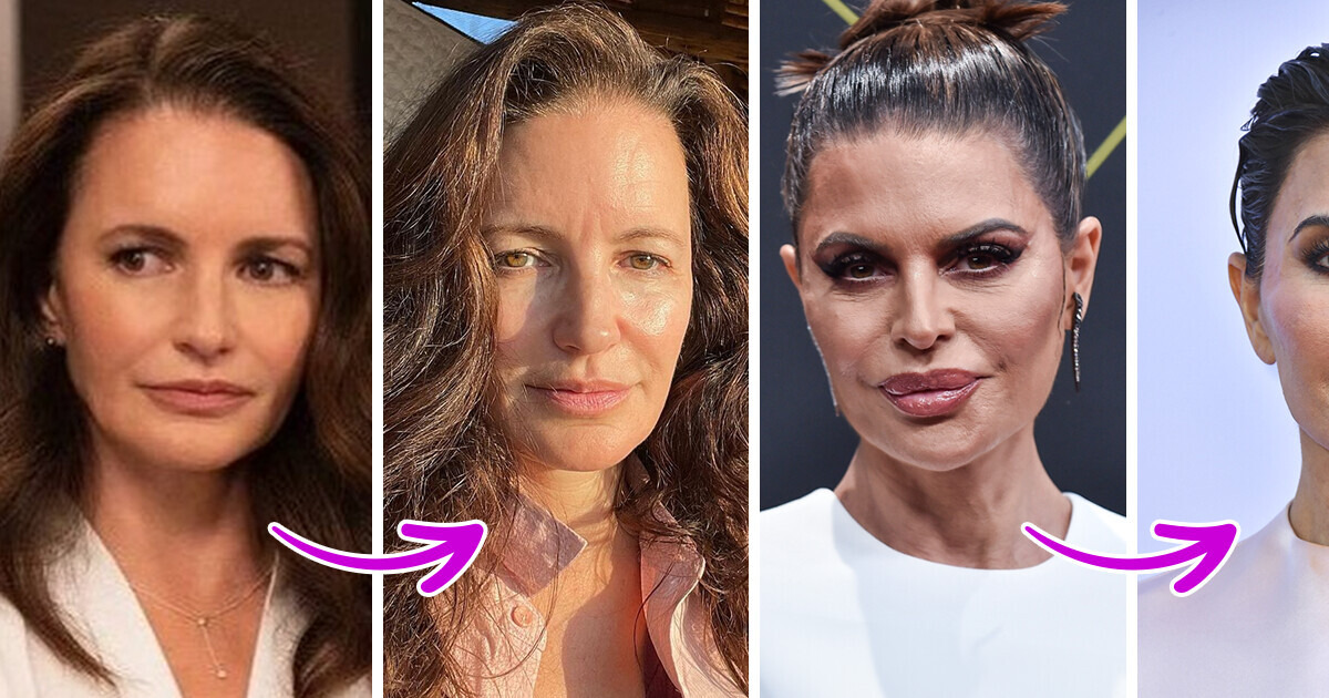5 Celebrities Who Regretted Their Facial Fillers and Had Them Removed 5 Celebrities Who Regretted Their Facial Fillers and Had Them Removed