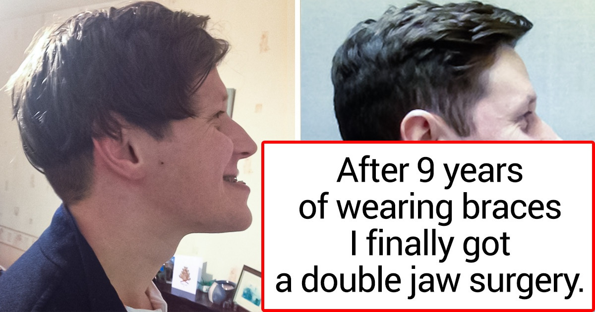 18 People Who Chose Plastic Surgery and Feel Better Than Ever on the Inside As Well