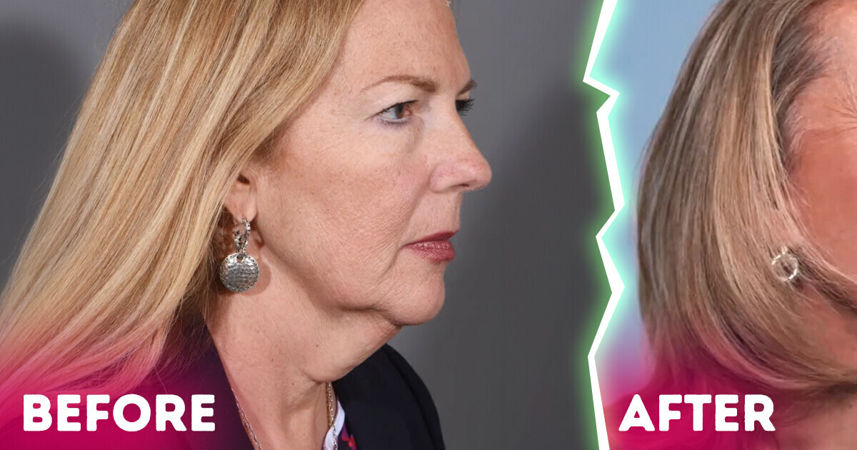 «She Dropped 20 Years,» a Woman Undergoes Surgery at 59, Leaving Everyone in Awe with Drastic Results