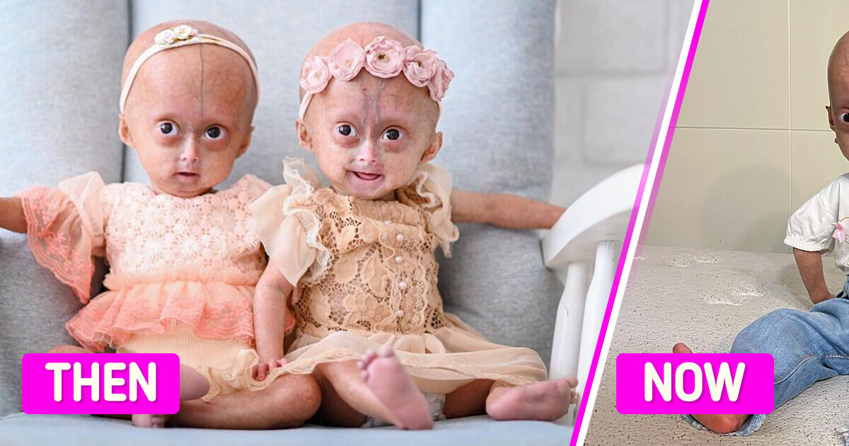 Meet Twins with the Rare Benjamin Button Syndrome, Who Became Symbols of Resilience Meet Twins with the Rare Benjamin Button Syndrome, Who Became Symbols of Resilience