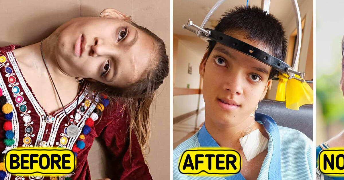 Shocking 90-Degree Neck Twist Was Finally Corrected, Giving Girl a New Life Shocking 90-Degree Neck Twist Was Finally Corrected, Giving Girl a New Life