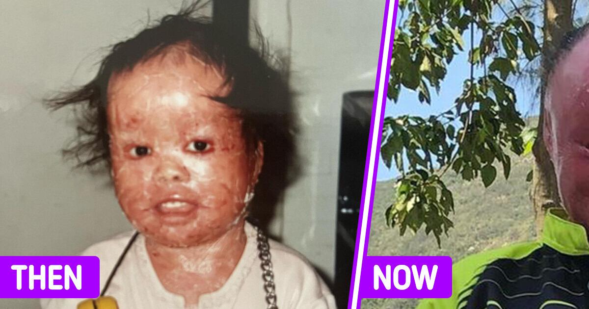 Couple Adopts a Red-Skinned Baby with Slim Chances of Survival, Raising Her into a True Champion