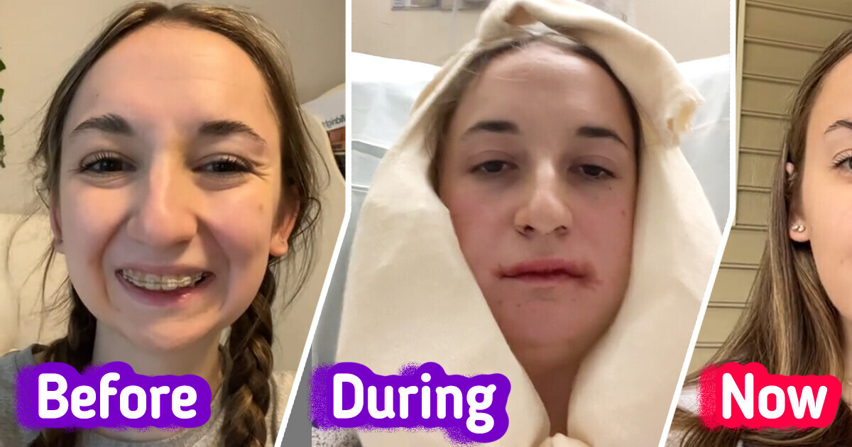 A Young Woman Goes Viral by Revealing the Drastic Results of Her Jaw Surgery, Leaving People in Awe A Young Woman Goes Viral by Revealing the Drastic Results of Her Jaw Surgery, Leaving People in Awe
