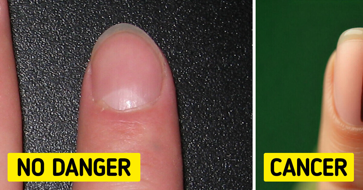 Mom of Four Spotted an Unusual Nail Mark — It Was a Hidden Cancer Warning Mom of Four Spotted an Unusual Nail Mark — It Was a Hidden Cancer Warning