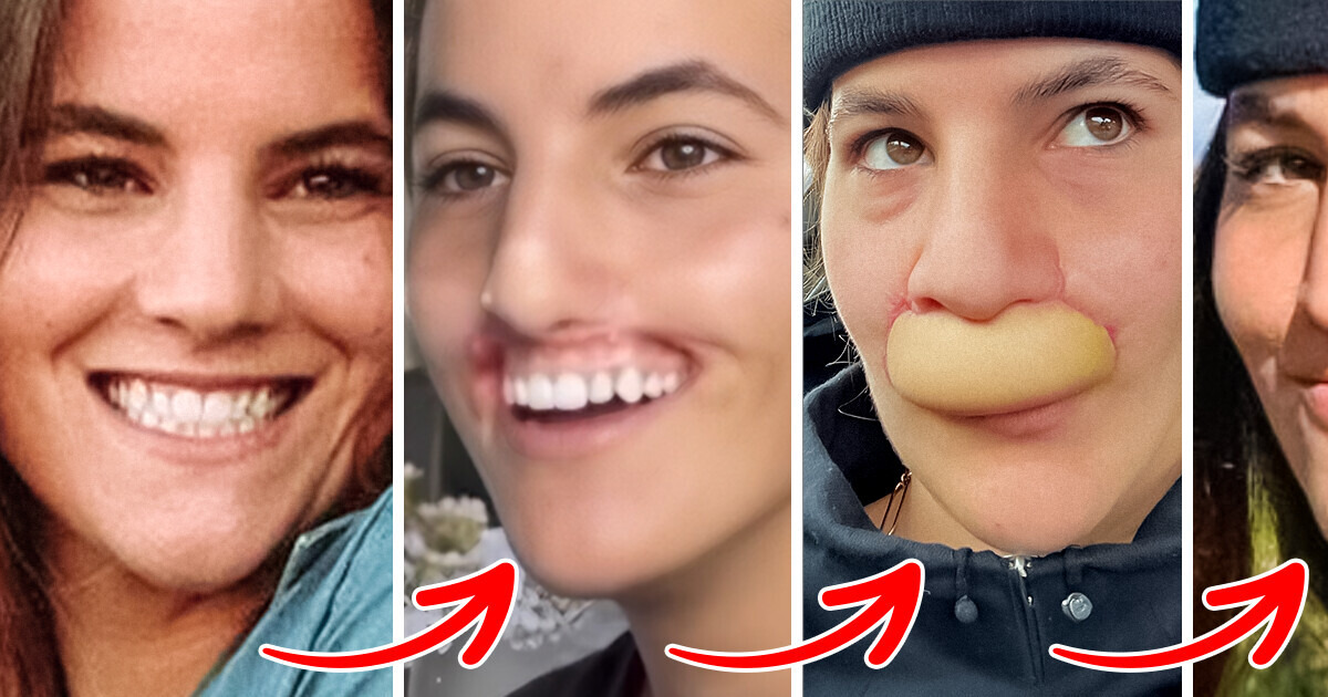 A Girl Was Attacked by a Pitbull. She Underwent Facial Reconstruction Surgery and Delighted Everyone With Her New Appearance