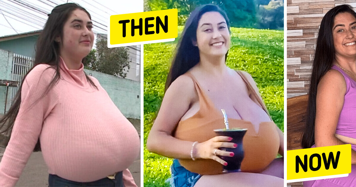 Girl’s 10kg (22lbs) Breast Surgery: The Shocking Reality of Gigantomastia Girl’s 10kg (22lbs) Breast Surgery: The Shocking Reality of Gigantomastia