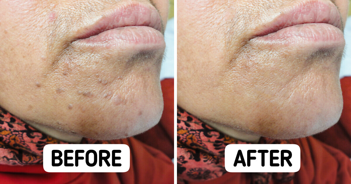 7 Practical Tips to Prevent and Treat Those Stubborn Bumps
