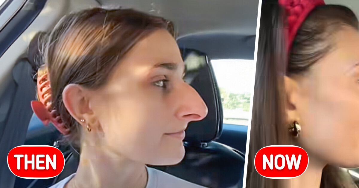 After Years of Dreaming She Finally Got a Nose Job and the Results Are Unbelievable After Years of Dreaming She Finally Got a Nose Job and the Results Are Unbelievable