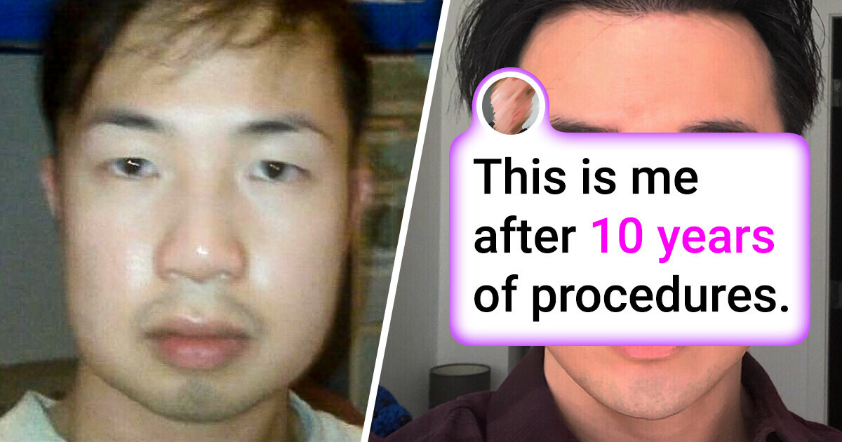 A Man Leaves People Speechless with Remarkable Results from 10 Years of Plastic Surgery A Man Leaves People Speechless with Remarkable Results from 10 Years of Plastic Surgery