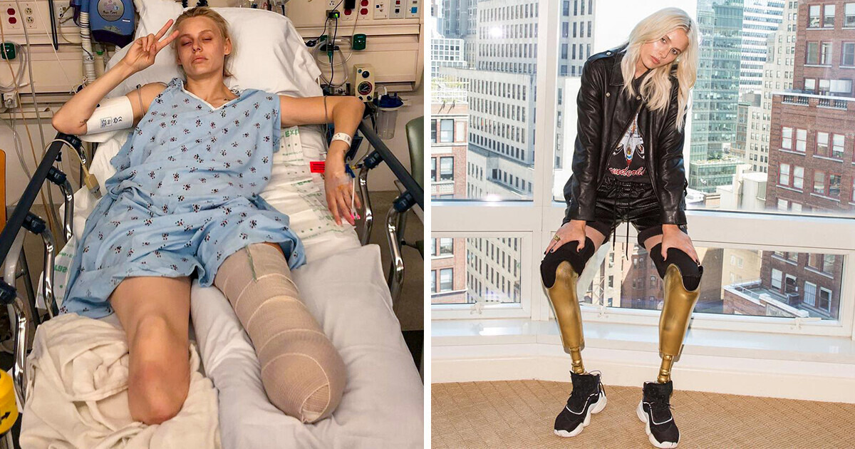 How Lauren Wasser Defied the Odds and Became a Model After Losing Both Legs Because of a Tampon How Lauren Wasser Defied the Odds and Became a Model After Losing Both Legs Because of a Tampon