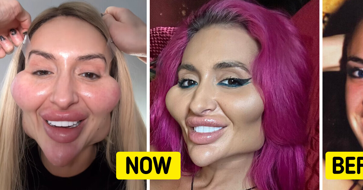 See How the Woman Who Now Has the World’s Biggest Cheeks Looked Like ...