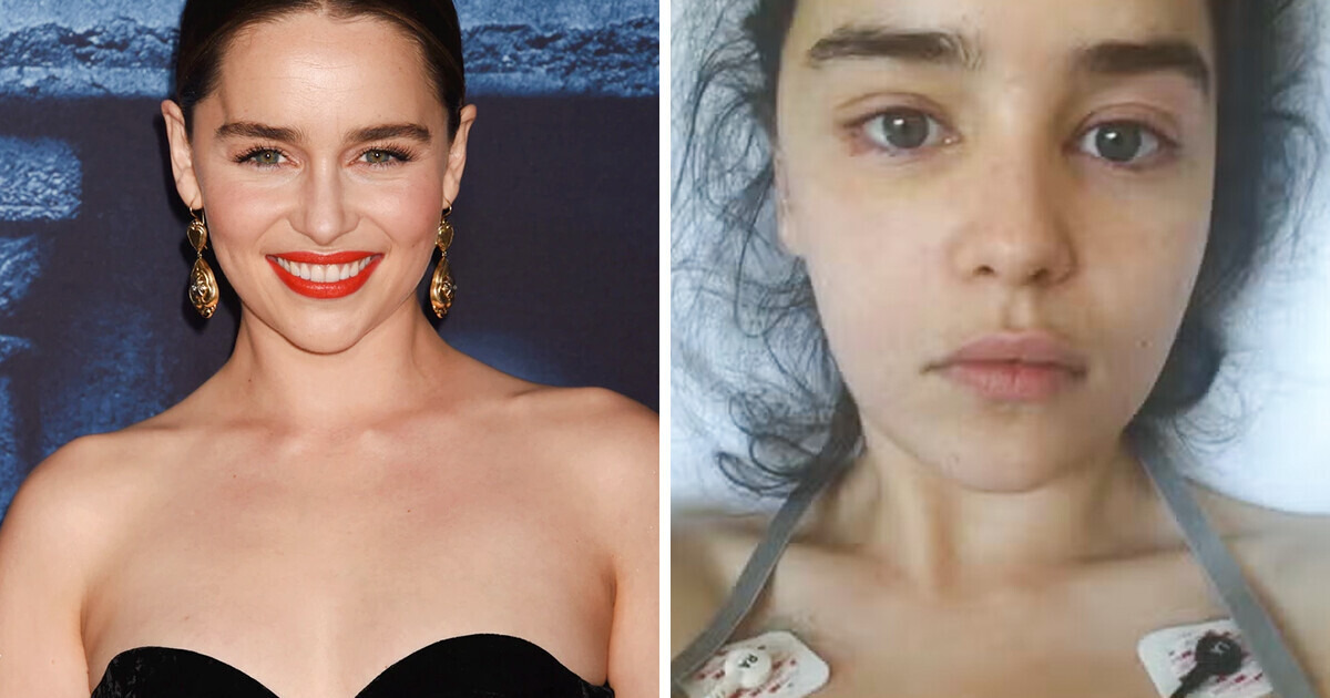 «The Amount of My Brain That is No Longer Usable,» Emilia Clarke’s Journey From Near-death to Helping Others Boom «The Amount of My Brain That is No Longer Usable,» Emilia Clarke’s Journey From Near-death to Helping Others Boom