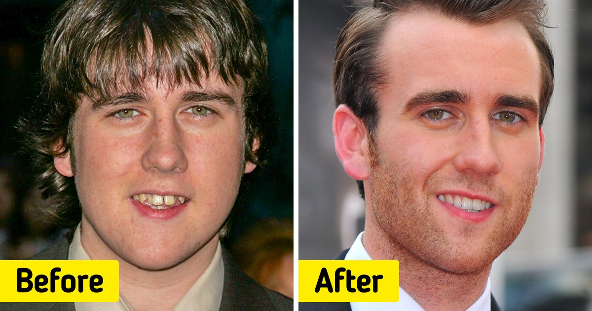 15 Celebrity Smiles That Remained Legendary Despite Transforming Through the Years