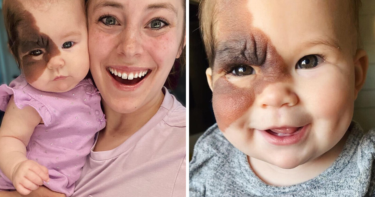 Mom of Baby With a Rare Birthmark Is Dedicated To Celebrating Her Unique Beauty Mom of Baby With a Rare Birthmark Is Dedicated To Celebrating Her Unique Beauty