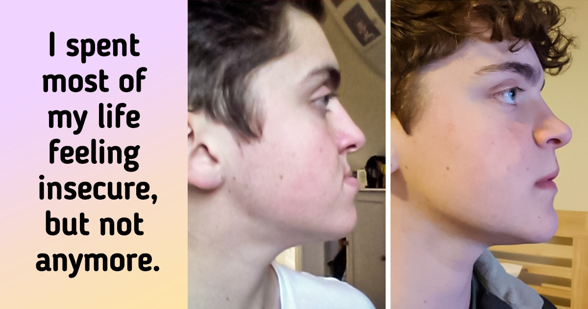 15 Fearless People Who Got Plastic Surgery and Now Are Proud of Their New Look
