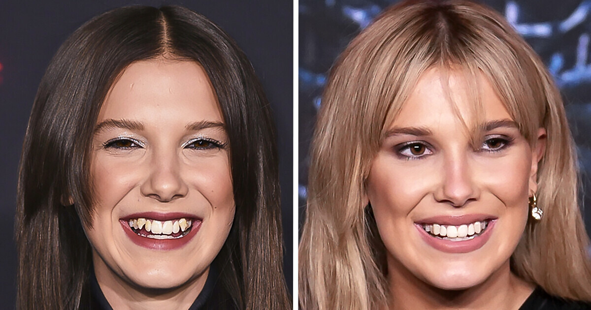 15+ Stars Who Prove That Fixing Your Teeth Can Be a Life-Changing Move 15+ Stars Who Prove That Fixing Your Teeth Can Be a Life-Changing Move