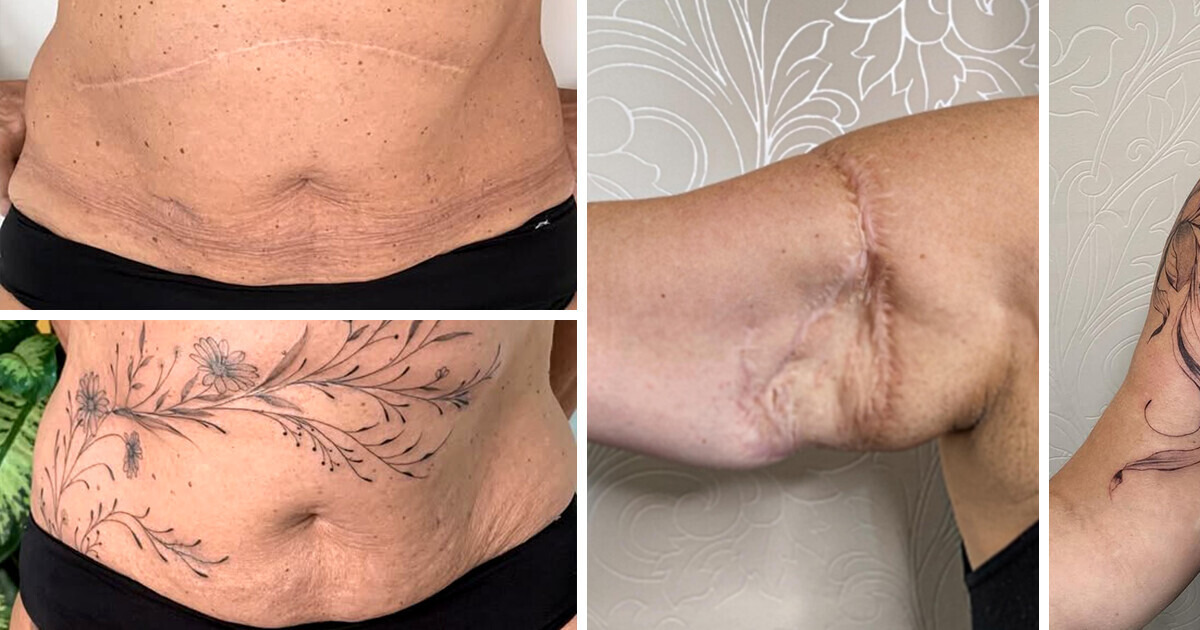 Artist Redefines Scars as Symbols of Strength and Beauty Artist Redefines Scars as Symbols of Strength and Beauty