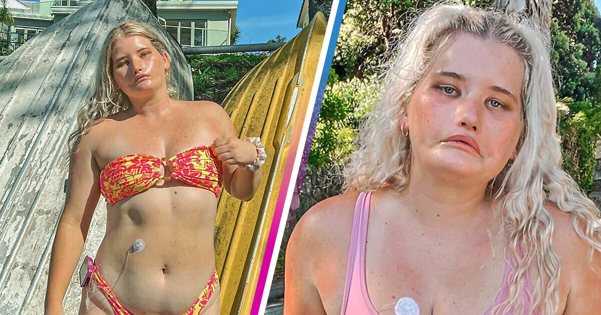 How “The Girl Who Can’t Smile” Embraced Her Unique Look and Achieved Success as a Model