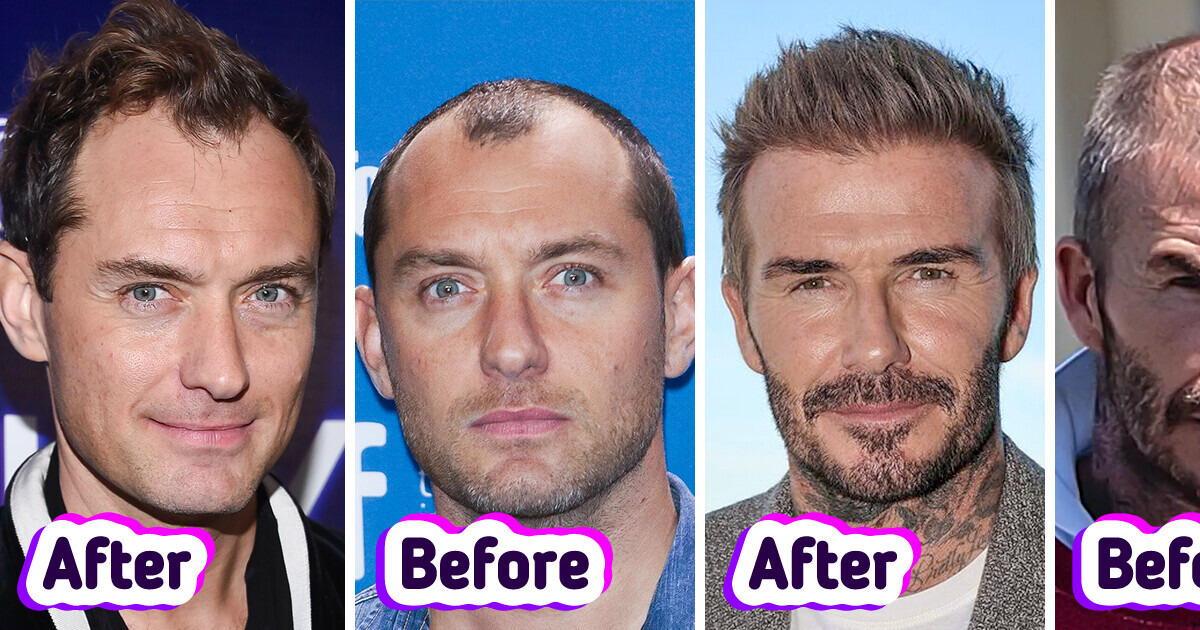 12 Before-and-After Photos of Male Celebrities Who Allegedly Received Hair Transplants 12 Before-and-After Photos of Male Celebrities Who Allegedly Received Hair Transplants