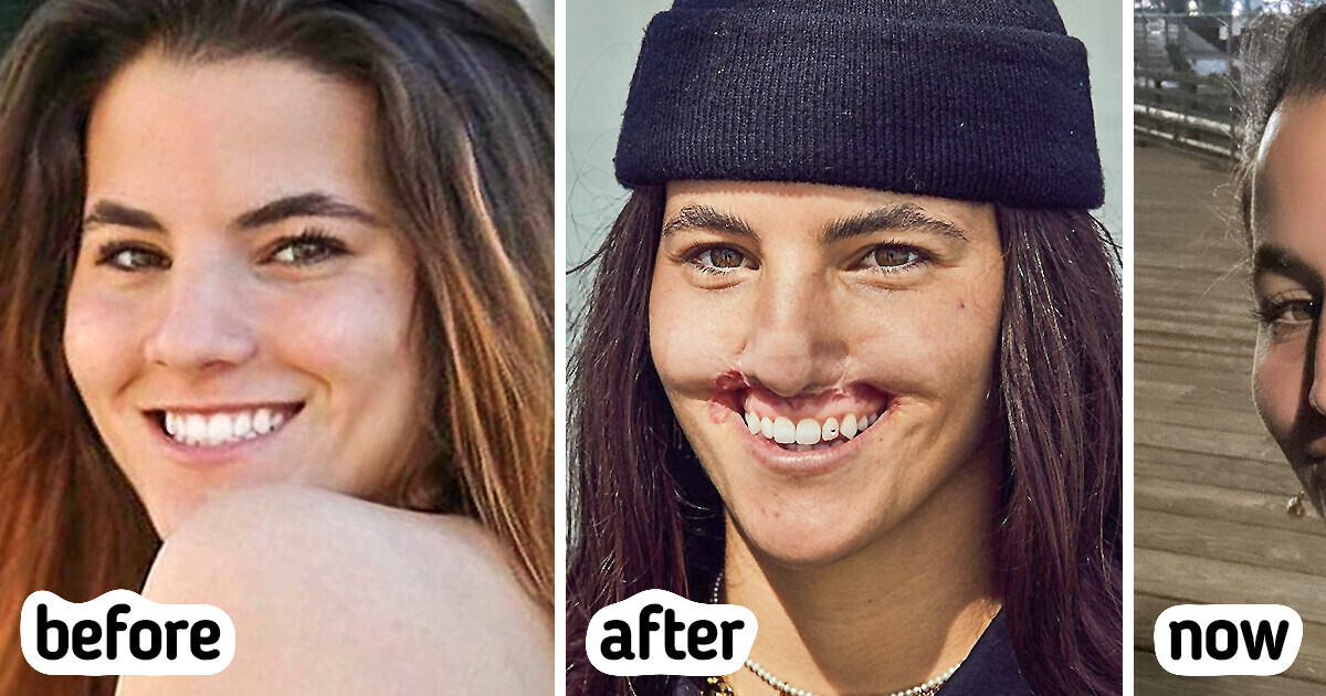 The Model Got Mauled by a Dog, and Her Journey To Embrace a New Look Is a Testament to Courage The Model Got Mauled by a Dog, and Her Journey To Embrace a New Look Is a Testament to Courage