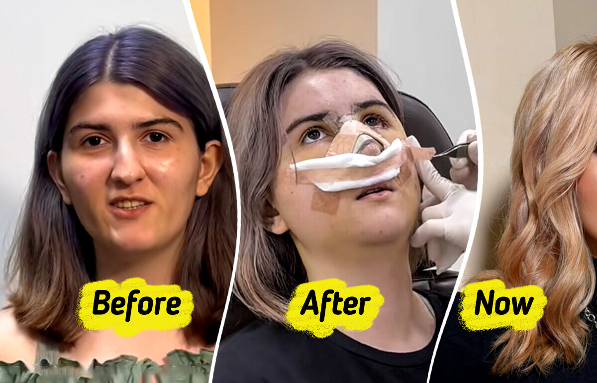 Woman Shares Drastic Plastic Surgery Results After Visiting South Korea, Sparking Heated Buzz Woman Shares Drastic Plastic Surgery Results After Visiting South Korea, Sparking Heated Buzz