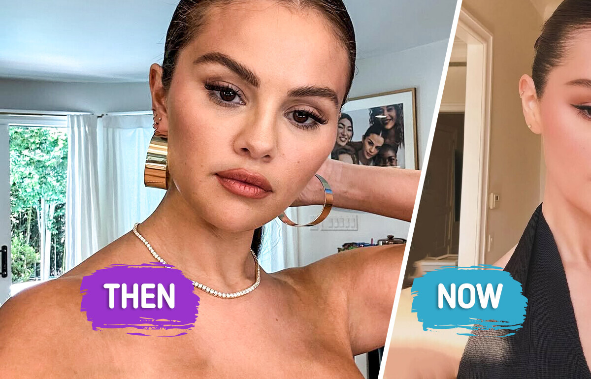 “She Got Filler and Cheek Implant!” Selena Gomez’s Stunning New Look Has Everyone Talking “She Got Filler and Cheek Implant!” Selena Gomez’s Stunning New Look Has Everyone Talking
