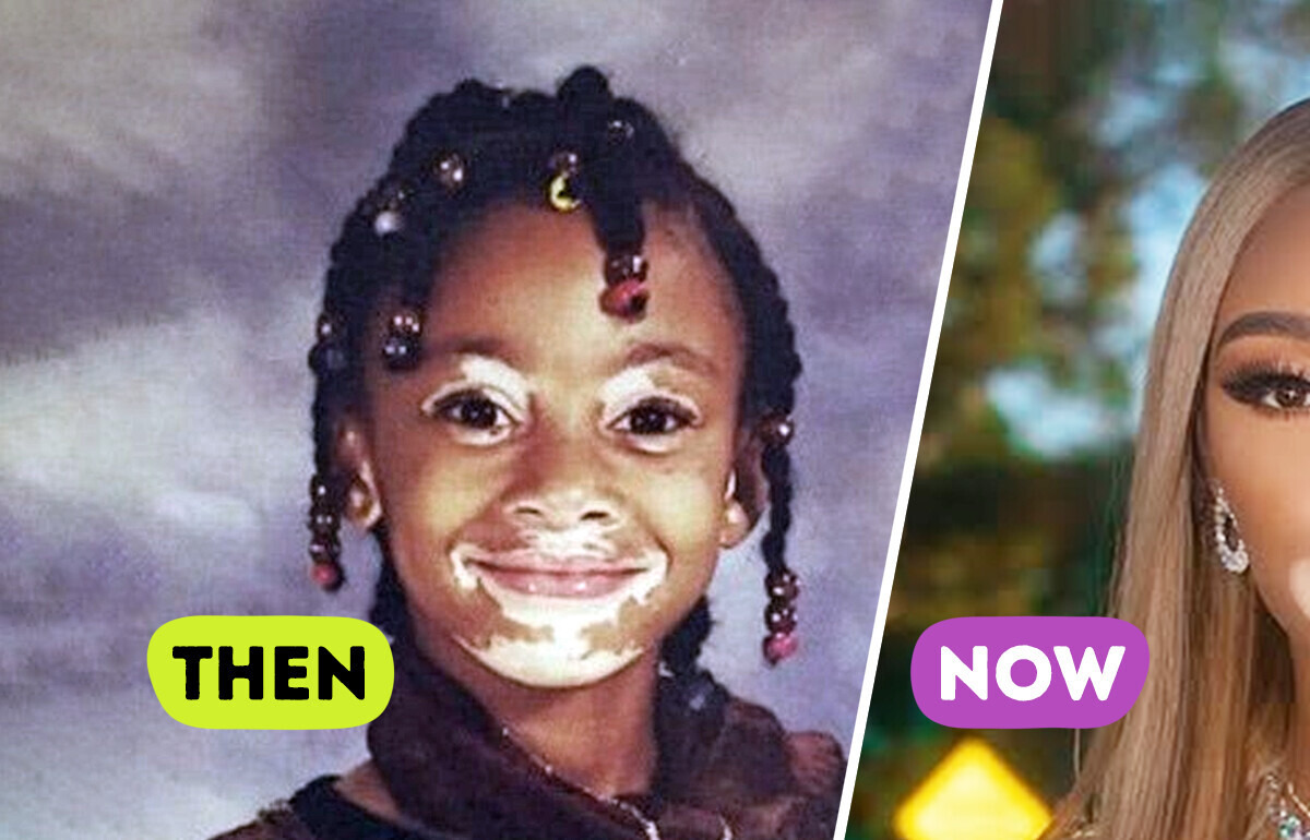 Meet Winnie Harlow, the Vitiligo Supermodel Breaking Beauty Rules Since Childhood