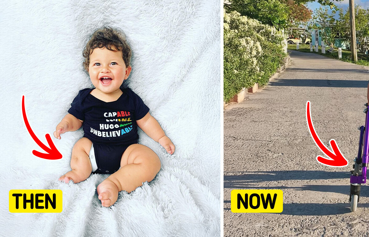 Doctors Were Speechless, but This Mom Saw Only Love — A Baby Born With Limb Differences Doctors Were Speechless, but This Mom Saw Only Love — A Baby Born With Limb Differences