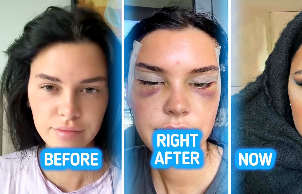 Young Woman’s Fox Eye Makeover Turns Heads as Viewers React to Controversial Results