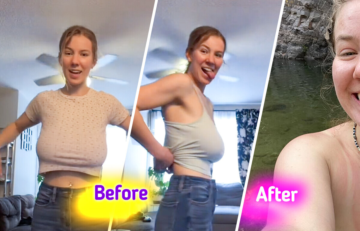 Woman Reveals Her Breast Reduction Journey, Leaving Everyone Stunned by the Results Woman Reveals Her Breast Reduction Journey, Leaving Everyone Stunned by the Results