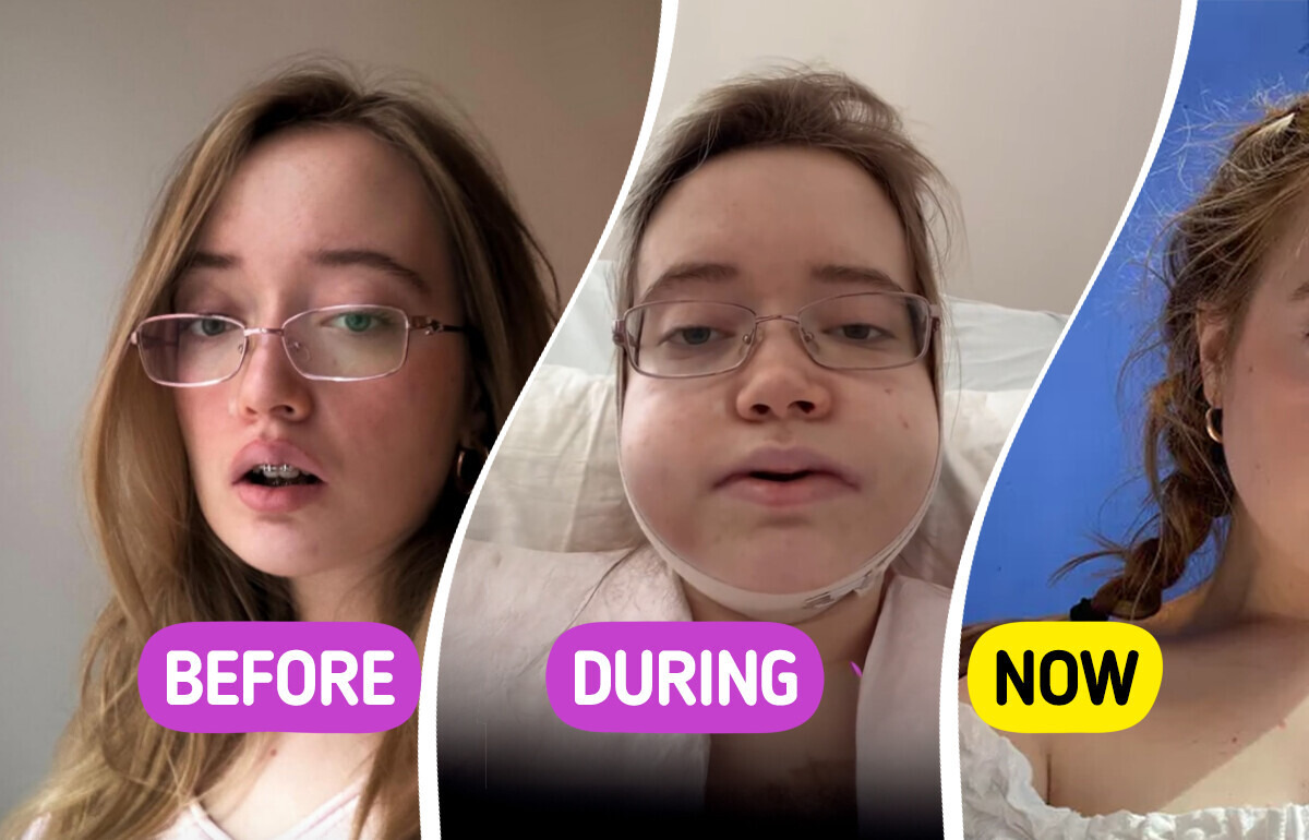 Young Singer Reveals Her Double Jaw Surgery Journey, Leaving People Stunned by the Results