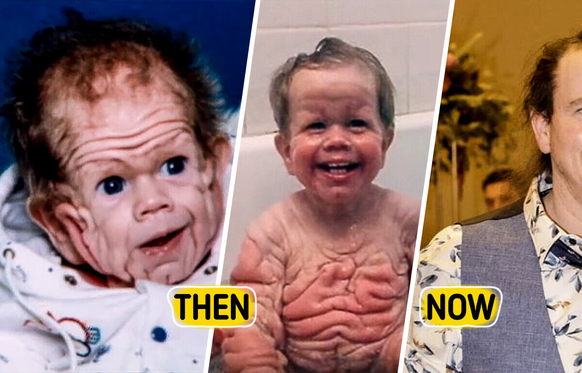 A Baby Was Born with a Rare Skin Condition That Confused Doctors for 20 Years — Now He Looks Completely Unrecognizable A Baby Was Born with a Rare Skin Condition That Confused Doctors for 20 Years — Now He Looks Completely Unrecognizable