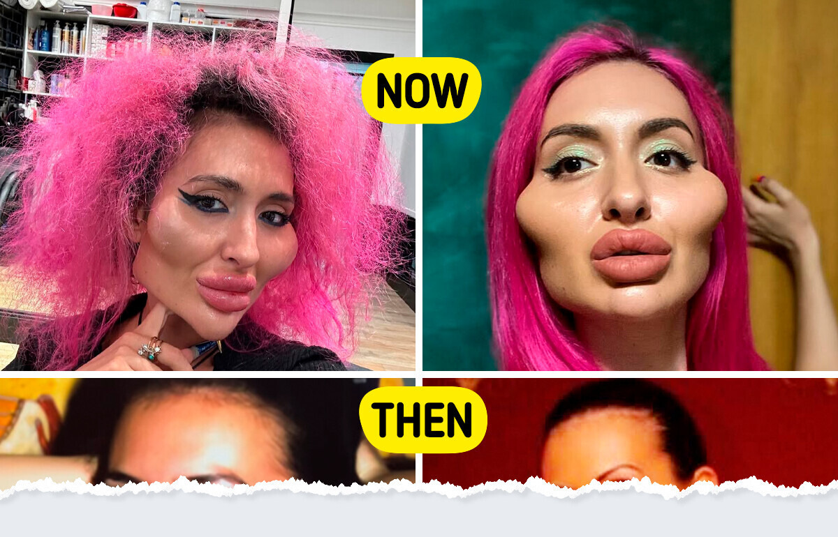See “Biggest Cheeks in the World” Star’s Face Before Cosmetic Procedures See “Biggest Cheeks in the World” Star’s Face Before Cosmetic Procedures