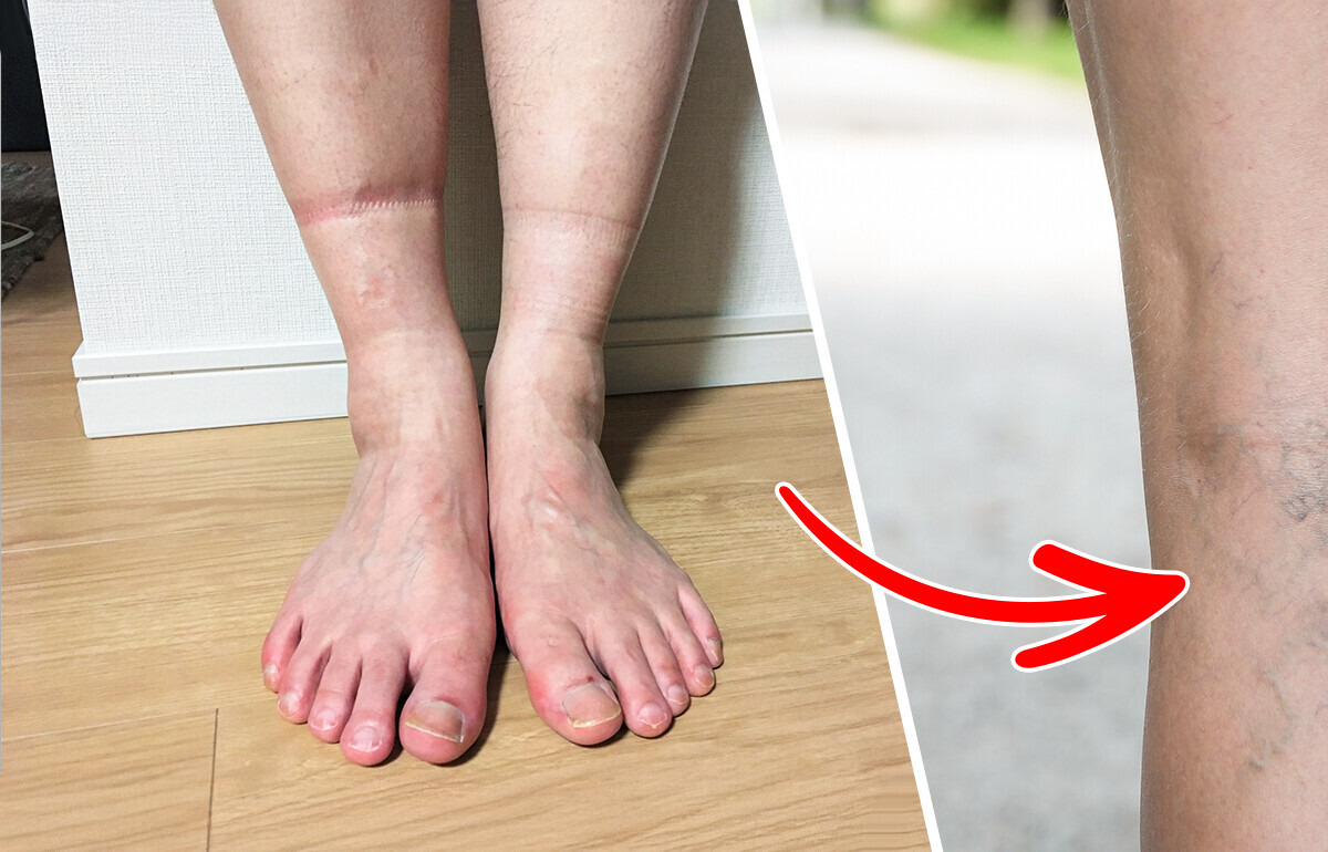 4 Health Problems Your Feet Could Be Telling You Through Sock Marks