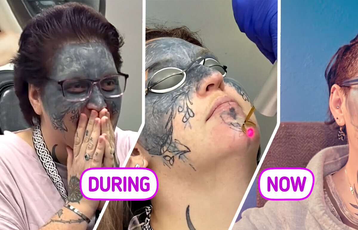 Woman’s Face Was Marked with Tattoos She Never Wanted — Now She’s Finally Erasing Them