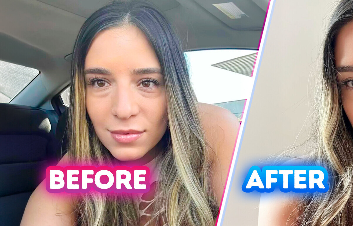 17 People Who Chose Plastic Surgery and Feel Happier Than Ever