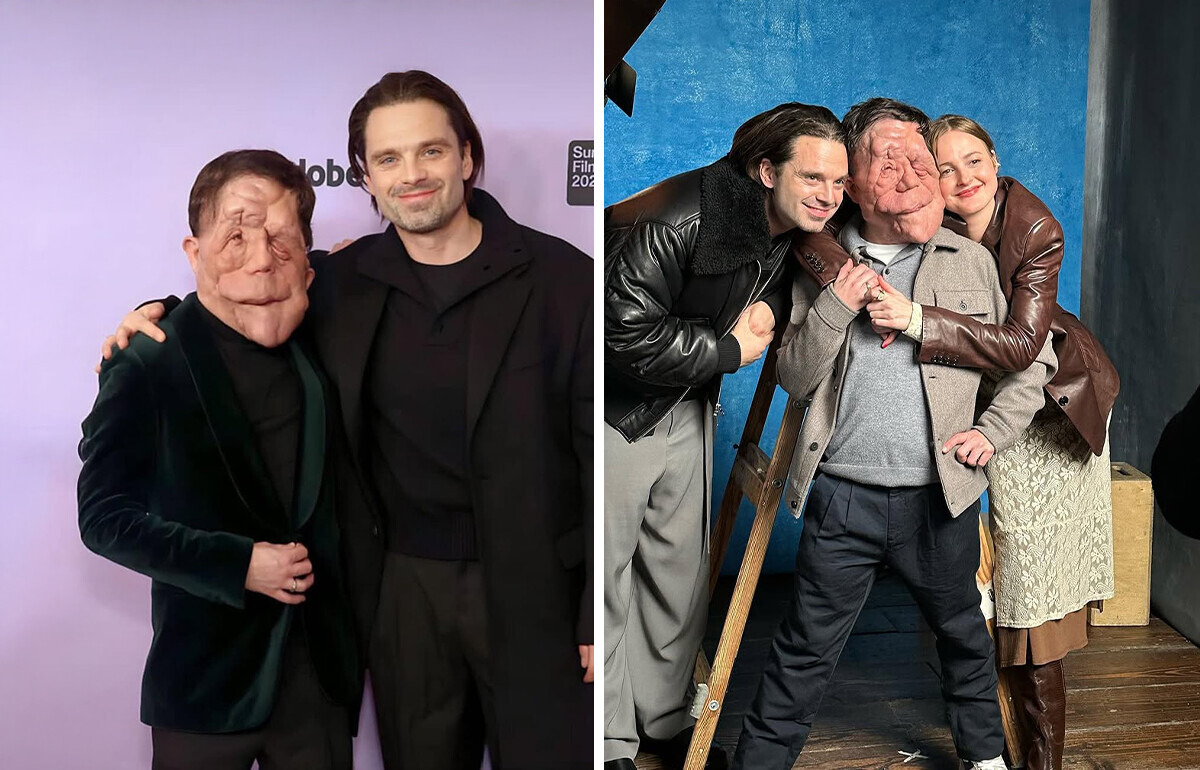 Born With a Rare Condition, He Now Acts With Hollywood Stars Born With a Rare Condition, He Now Acts With Hollywood Stars