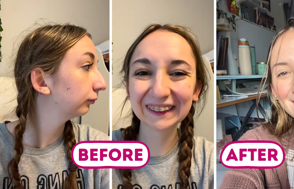 Young Woman Reveals Stunning Jaw Surgery Results That Leave People Speechless Young Woman Reveals Stunning Jaw Surgery Results That Leave People Speechless