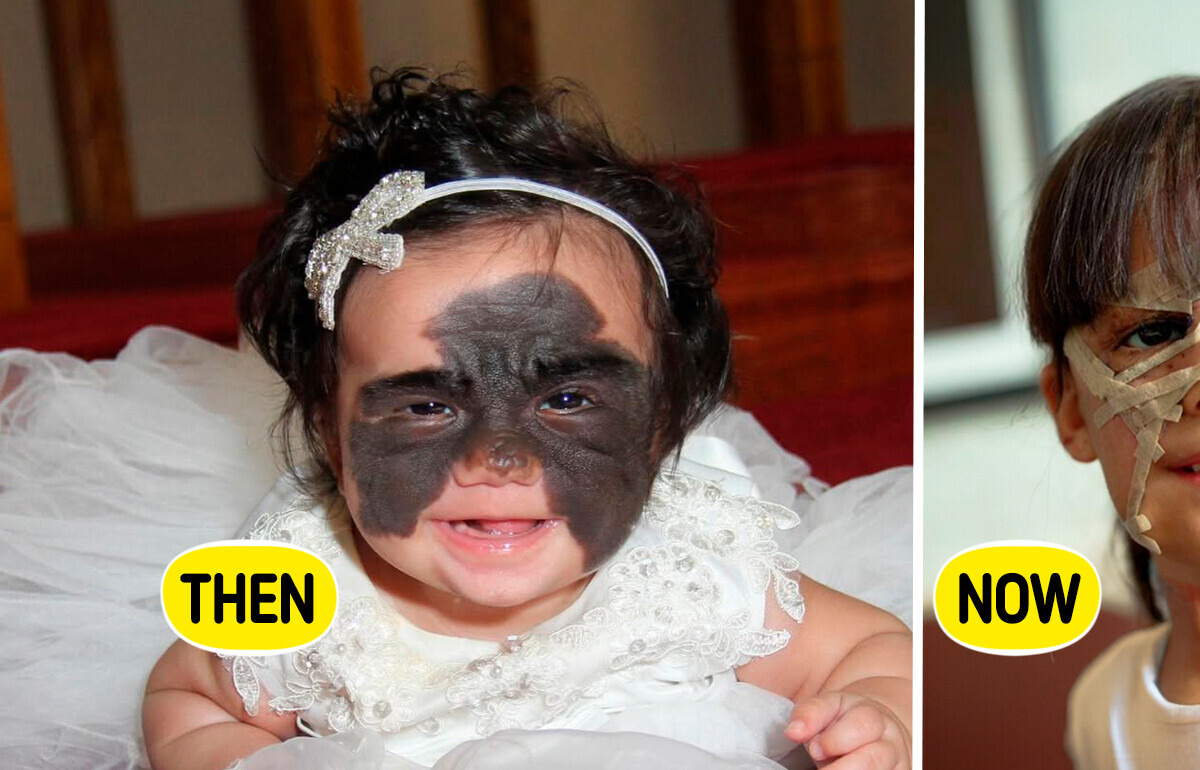 Girl With Batman Mask Birthmark Was Called a Monster Now She Is Absolutely Enchanting Girl With Batman Mask Birthmark Was Called a Monster Now She Is Absolutely Enchanting