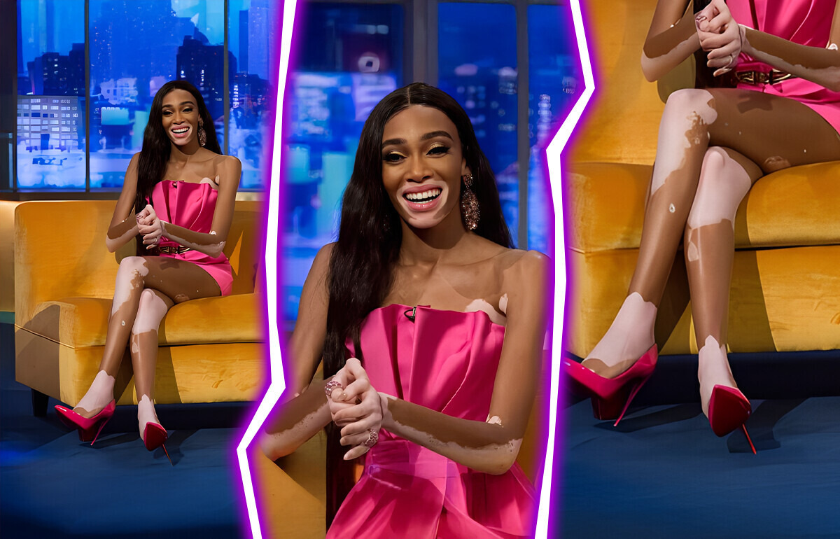 Meet Winnie Harlow, a Vitiligo Supermodel Winning Against Beauty Stereotypes Meet Winnie Harlow, a Vitiligo Supermodel Winning Against Beauty Stereotypes