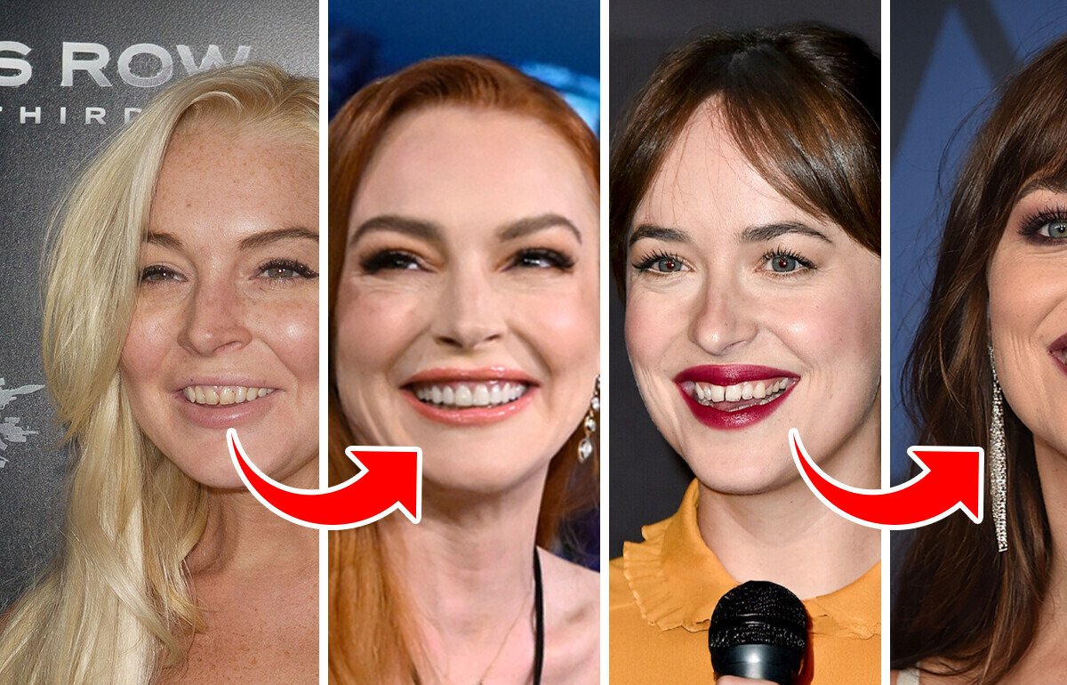 14 Celebrities Who Got New Teeth and Transformed Dramatically