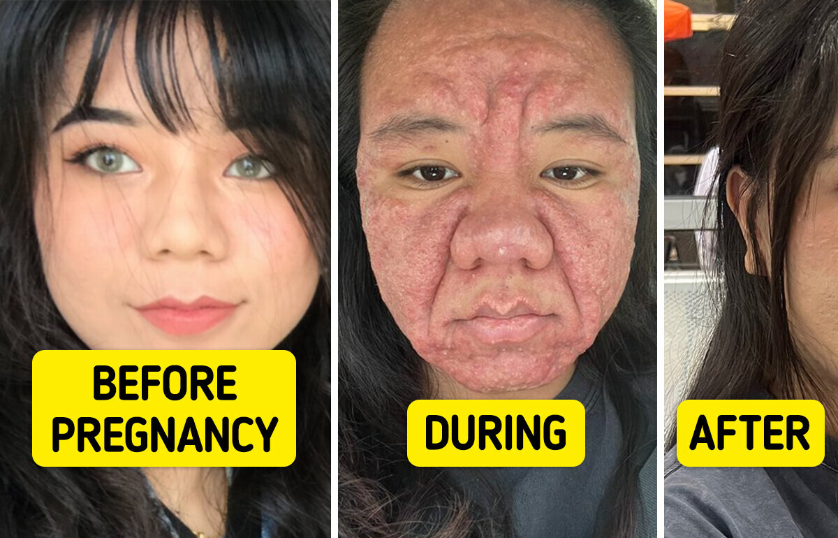 28-Year-Old Woman Reveals Shocking Face Changes During Pregnancy