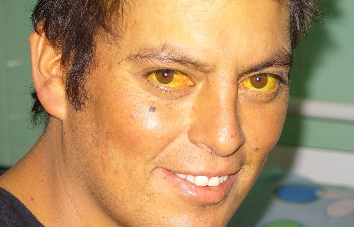 7 Silent Signs Your Body Could Be Warning You About Pancreatic Cancer